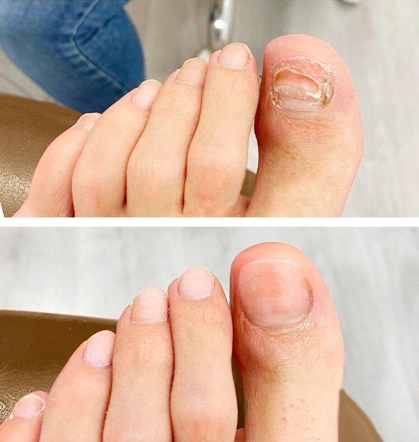 Deconstrucción ungueal Clinica del Peu