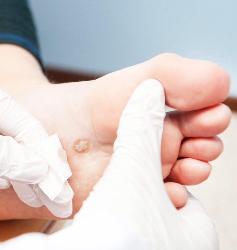 Verrugas en Sant adria de besos y ciuta vella